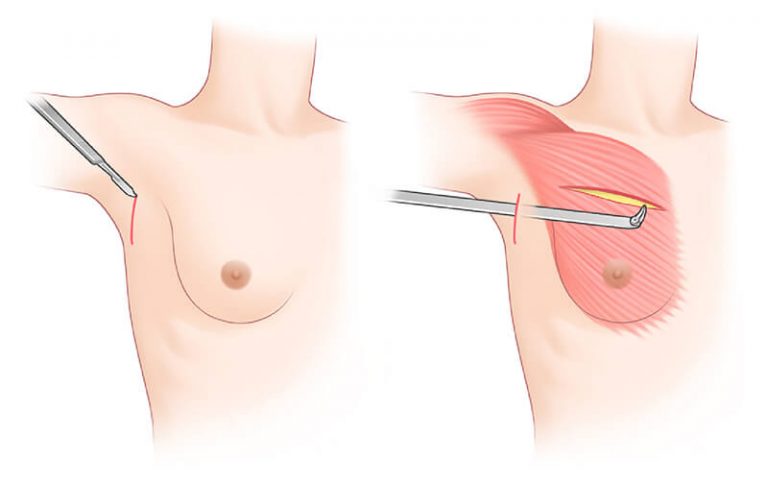 تکنیک بازسازی سینه