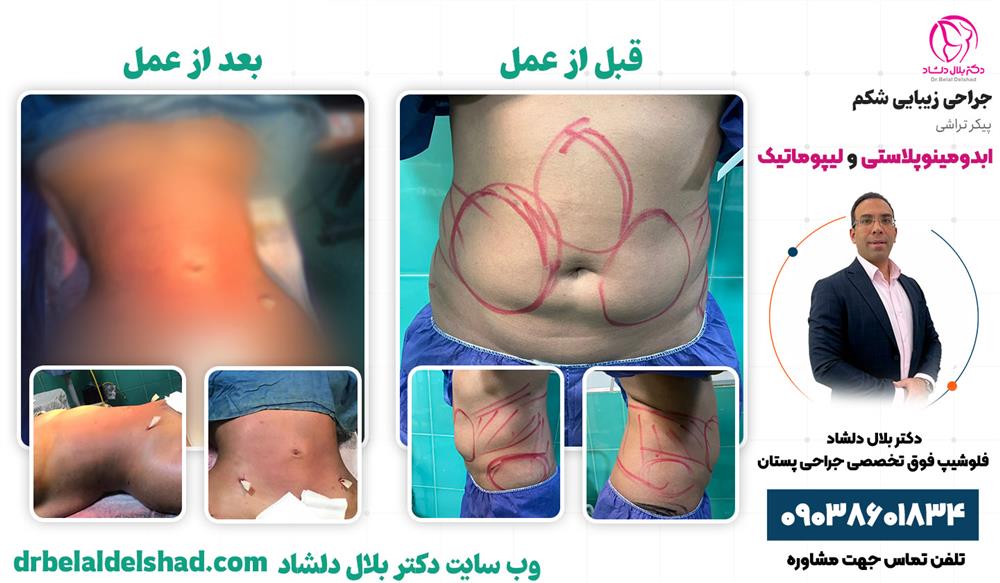 نمونه عمل ابدومینوپلاستی در کرج