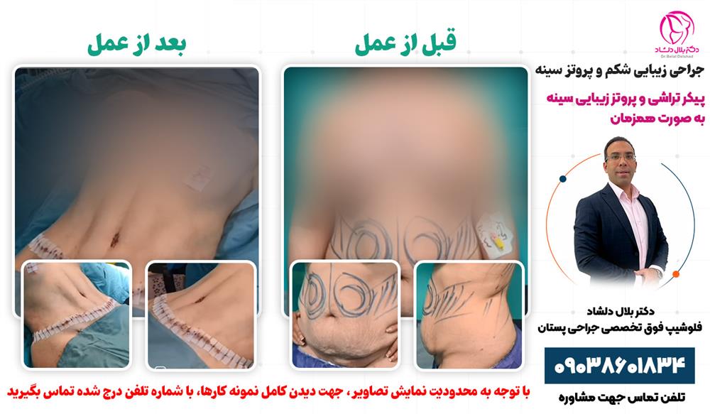 عمل ابدومینوپلاستی، لیپوماتیک و پروتز سینه به صورت همزمان در کرج، بیمارستان مریم