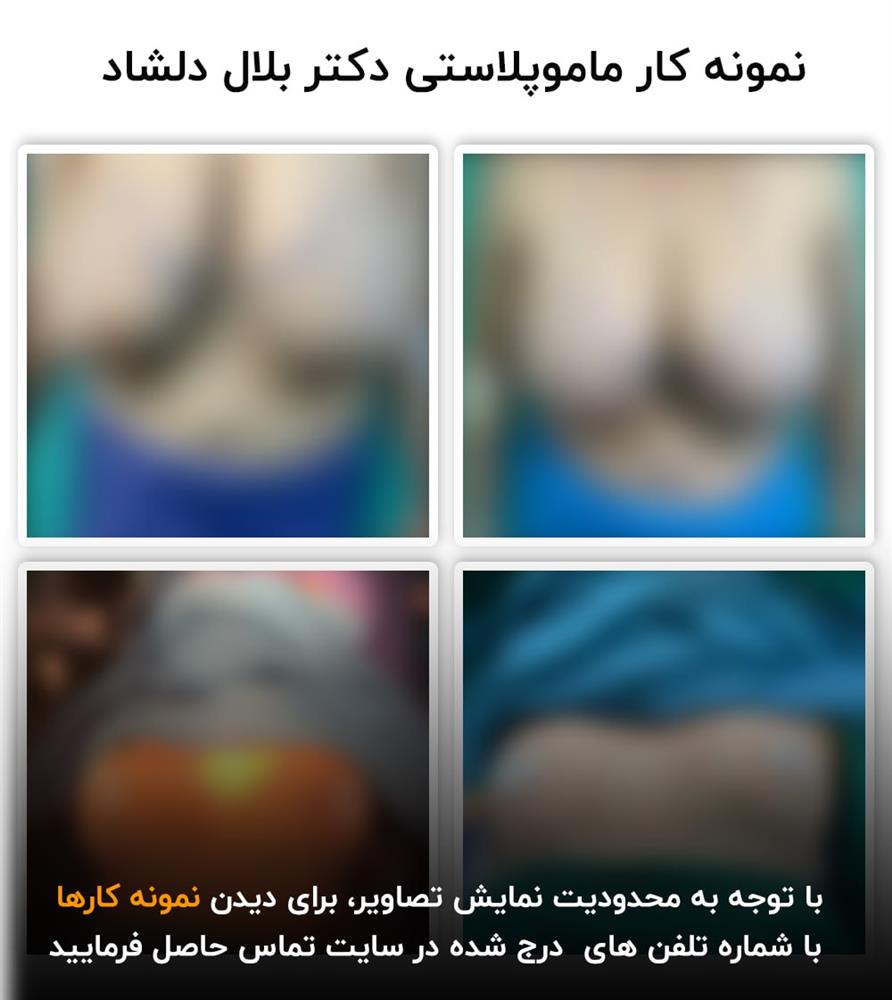 نمونه کار ماموپلاستی در کرج