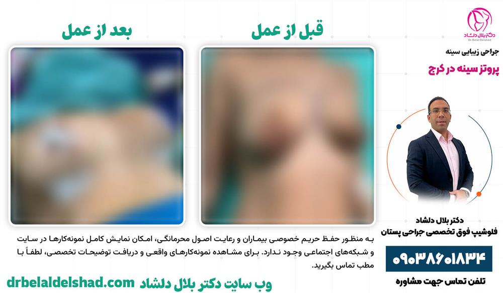 نمونه عمل پروتز سینه در کرج توسط دکتر بلال دلشاد