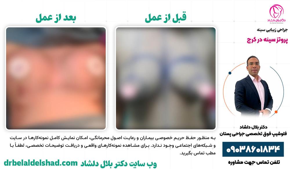 نمونه عمل پروتز سینه در کرج توسط دکتر بلال دلشاد