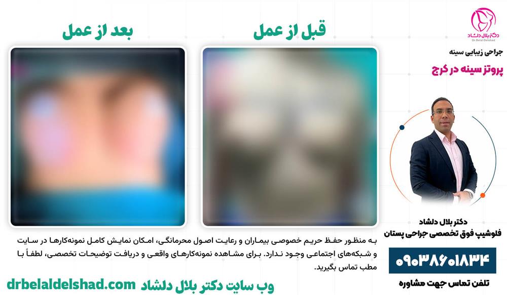 نمونه عمل پروتز سینه در کرج توسط دکتر بلال دلشاد
