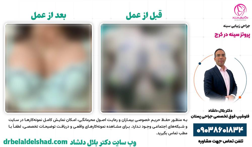 نمونه عمل پروتز سینه در کرج توسط دکتر بلال دلشاد