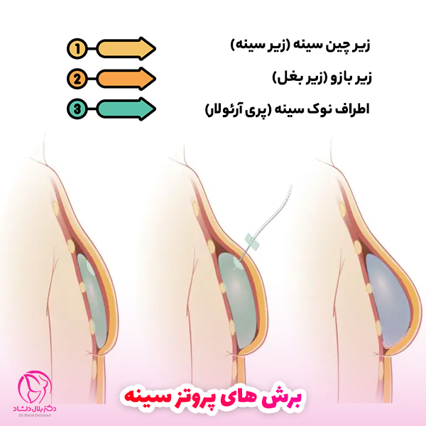 انواع مدل های برش جراحی پروتز سینه