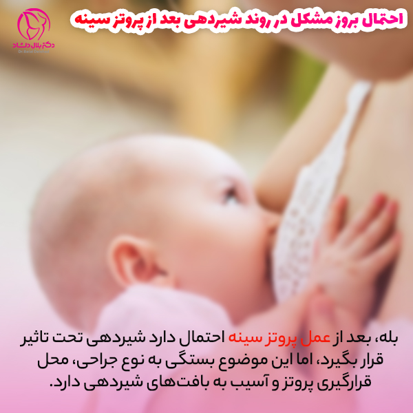 آیا بعد از عمل پروتز سینه شیردهی تحت تاثیر قرار می گیرد؟