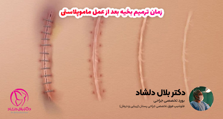 عمل ماموپلاستی چقدر طول میکشد+آیا بعدماموپلاستی می‌توان رابطه داشت+ماموپلاستی با بیمه تکمیلی انجام می‌شود+ماموپلاستی و شیردهی