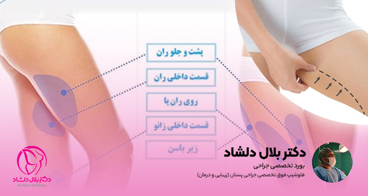 آیا لیپوماتیک بازو درد دارد+آیا لیپوماتیک ران درد دارد+بعد از اسلیو معده دوباره چاق می‌شویم+چرا بعد از عمل ابدومینوپلاستی باید گن پوشید