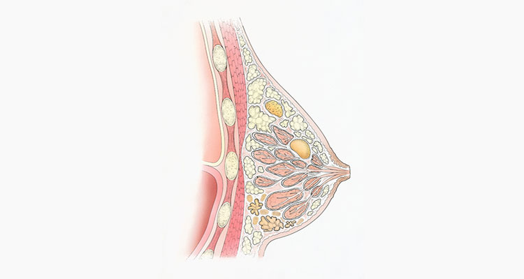فیبروکیستیک سینه چیست و چه علائمی ‌دارد؟