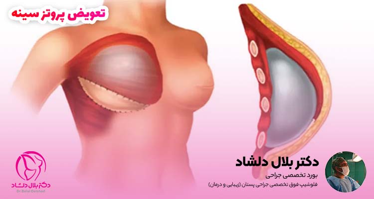 تعویض پروتز سینه