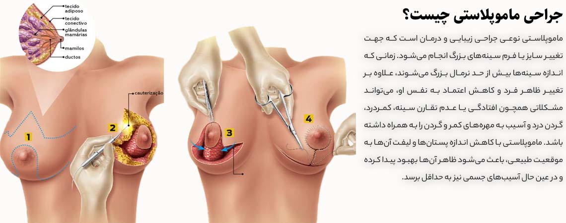 ماموپلاستی در کرج