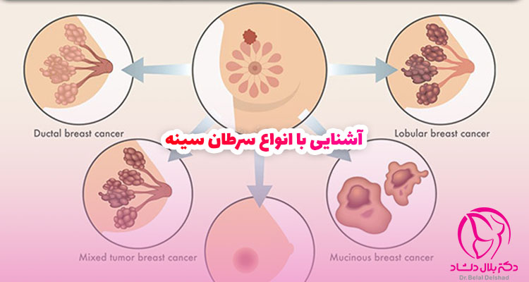 آشنایی با انواع سرطان سینه