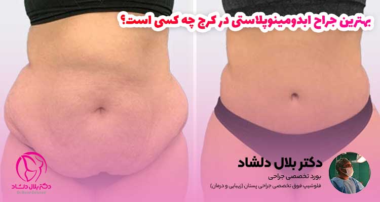 بهترین جراح ابدومینوپلاستی در کرج چه کسی است؟
