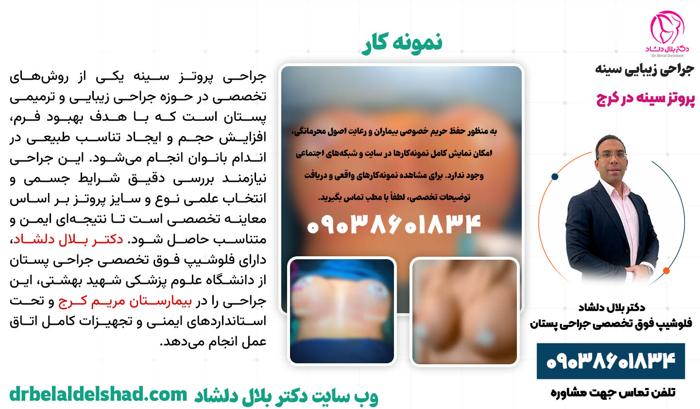 پروتز سینه در کرج (مراحل، هزینه و نمونه کار قبل و بعد) 